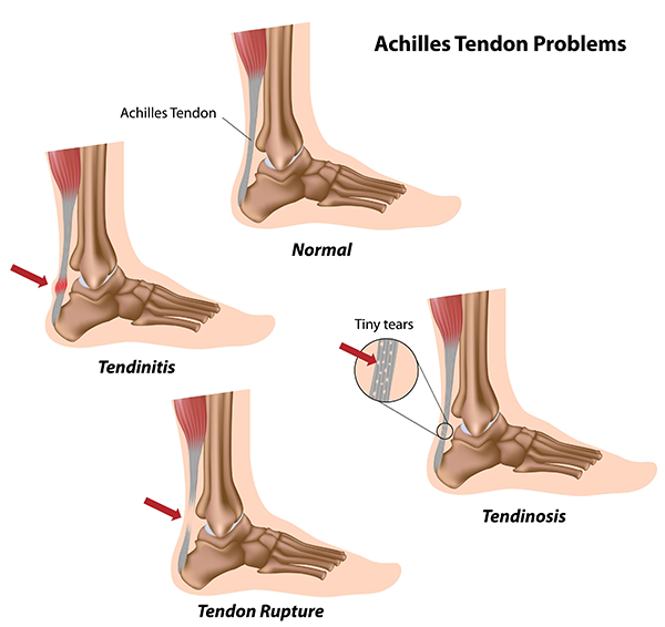 archilles tendonitis